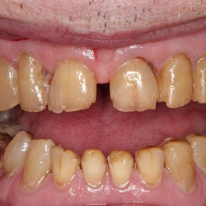 before dental care