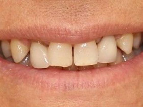 Dental Crowns Case 2 - Before