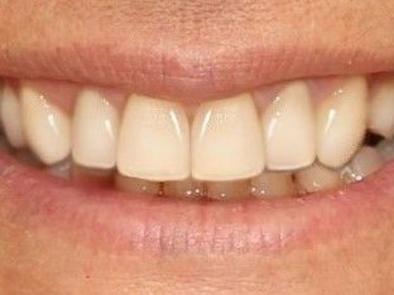 Dental Crowns Case 2 - After