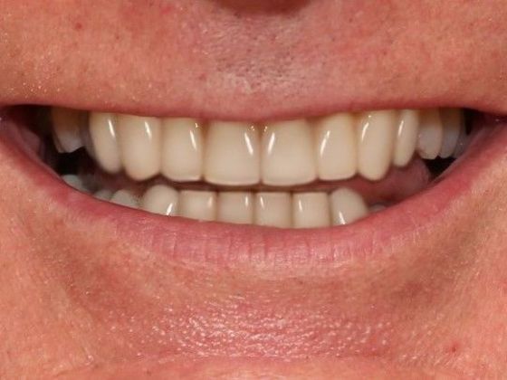 Dental Crowns Case 3 - After