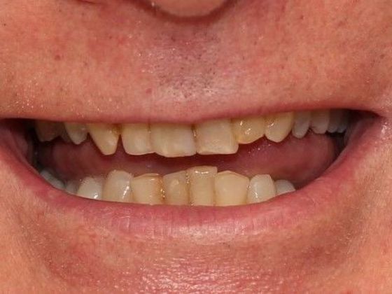 Dental Crowns Case 3 - Before