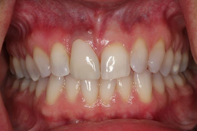 Dental Crowns Case 4 - After