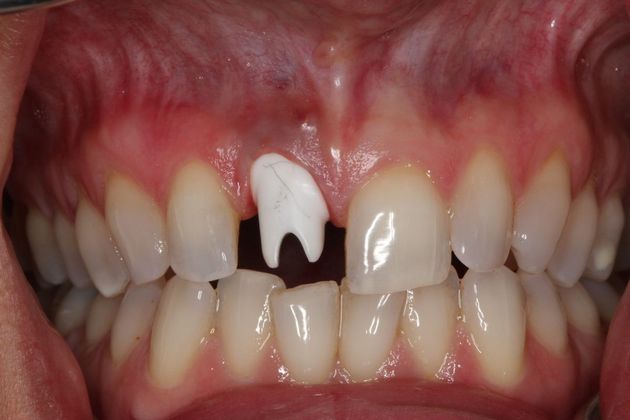 Dental Crowns Case 4 - Before