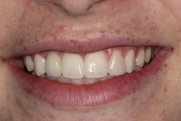 Dental Crowns Case 5 - After