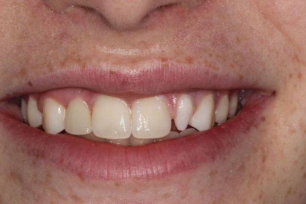 Dental Crowns Case 5 - Before