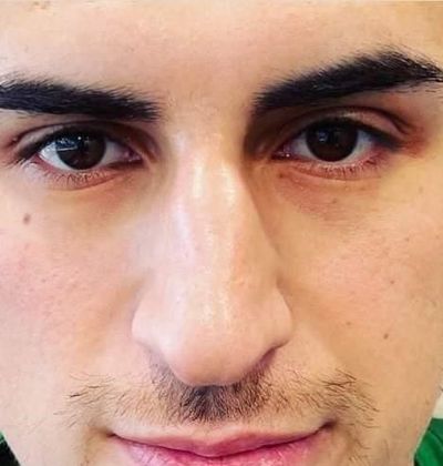 Liquid Rhinoplasty: Case 1 Liquid Rhinoplasty Scarsdale, NY - Before