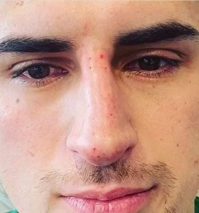 Liquid Rhinoplasty: Case 1 Liquid Rhinoplasty Scarsdale, NY - After