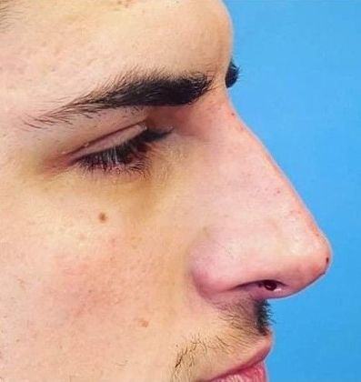 Liquid Rhinoplasty: Case 1 Liquid Rhinoplasty Scarsdale, NY - After