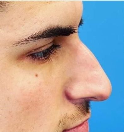 Liquid Rhinoplasty: Case 1 Liquid Rhinoplasty Scarsdale, NY - Before