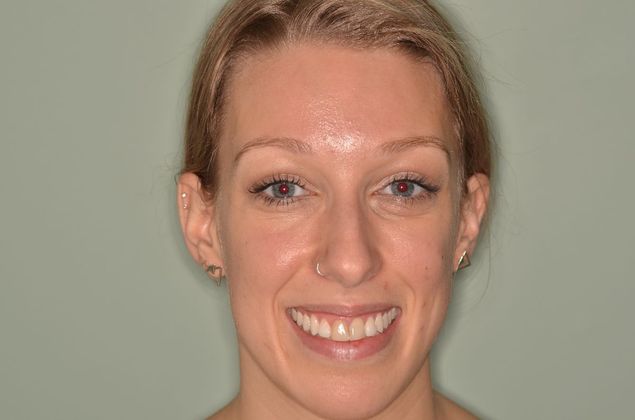 Porcelain Veneers: Case 27 - Before Porcelain veneers