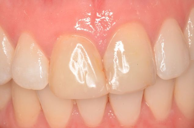 Porcelain Veneers: Case 27 - Before Porcelain veneers