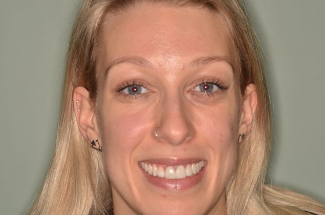 Porcelain Veneers: Case 27 - After Porcelain veneers