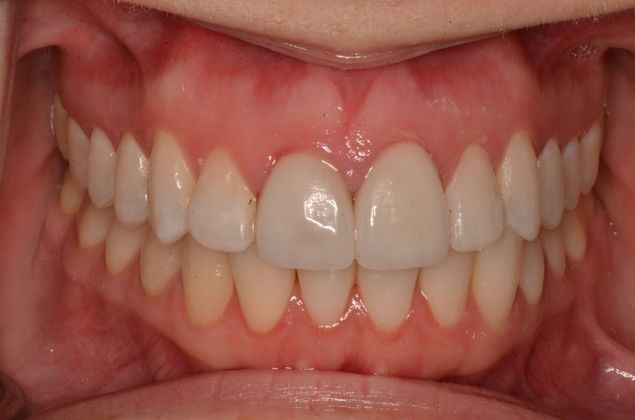 Porcelain Veneers: Case 27 - After Porcelain veneers