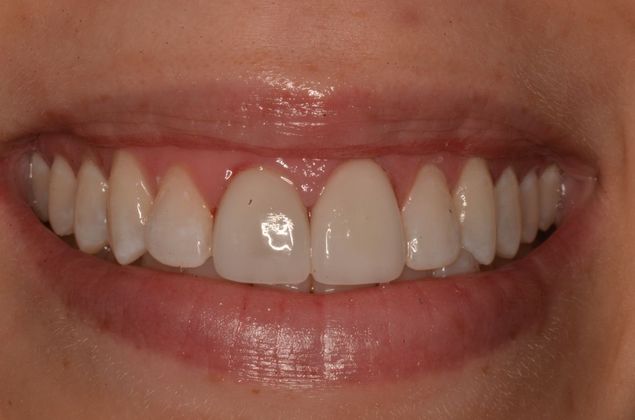 Porcelain Veneers: Case 27 - After Porcelain veneers