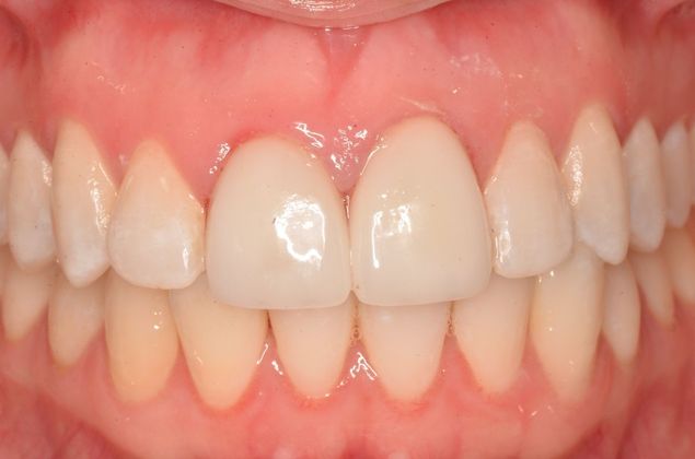 Porcelain Veneers: Case 27 - After Porcelain veneers