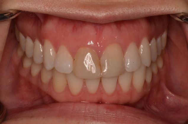 Porcelain Veneers: Case 27 - Before Porcelain veneers
