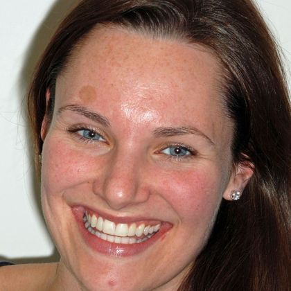 Porcelain Bridges Ingrid  - After