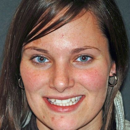 Porcelain Bridges Ingrid  - Before