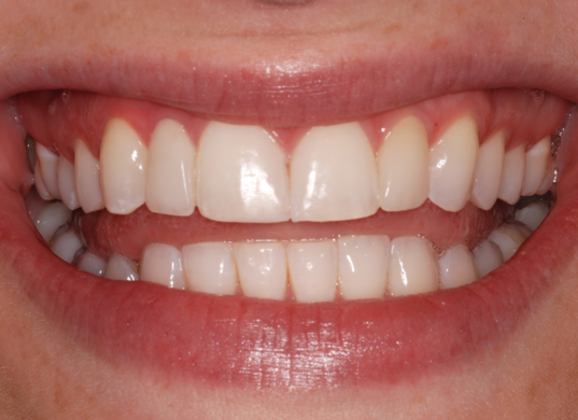 Porcelain Bridges: Ingrid - After