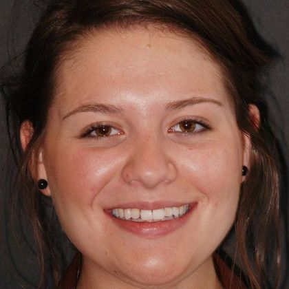 Cosmetic Bonding Career Ready - Before