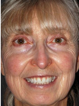 Invisalign: Deborah B. - Before