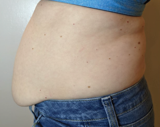 Ultimate Contour™ Case 1 - Before