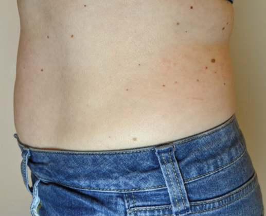 Ultimate Contour™ Case 1 - After