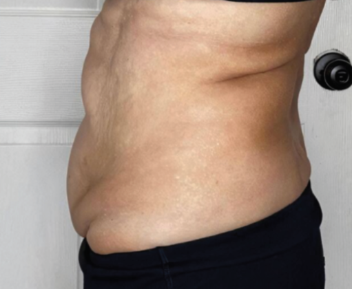 Ultimate Contour™: Case 2 - After 1 Treatment