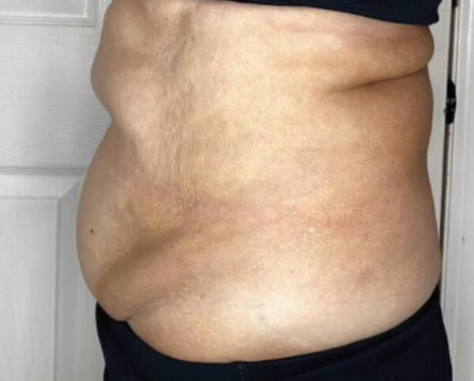 Ultimate Contour™: Case 2 - Before