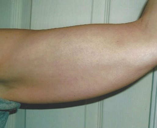 Ultimate Contour™: Case 3 - After 6 Treatments