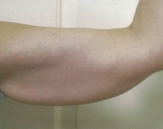 Ultimate Contour™: Case 3 - Before