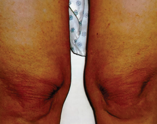 Ultimate Contour™ Case 4 - After