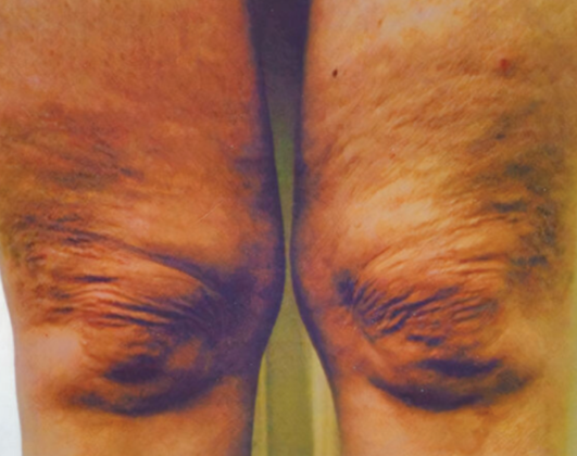 Ultimate Contour™ Case 4 - Before