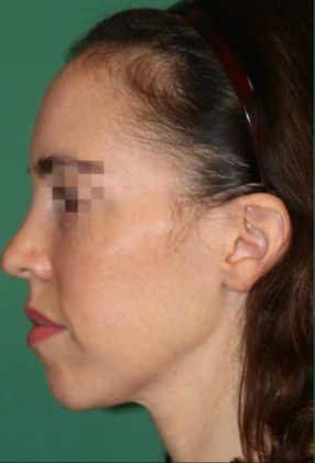 Hairline Lowering Surgery: Case 16 - Before