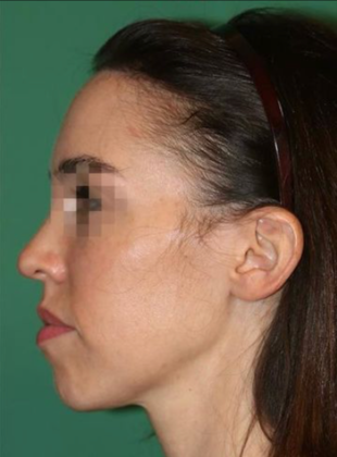 Hairline Lowering Surgery: Case 16 - After