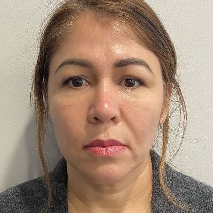 Facelift: Case 29 Facelift, eyelids Fairfield, CT - Before