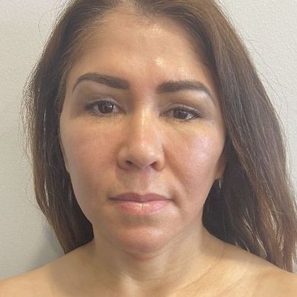 Facelift: Case 29 Facelift, eyelids Fairfield, CT - After