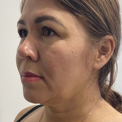 Facelift: Case 29 Facelift, eyelids Fairfield, CT - Before