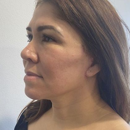 Facelift: Case 29 Facelift, eyelids Fairfield, CT - After