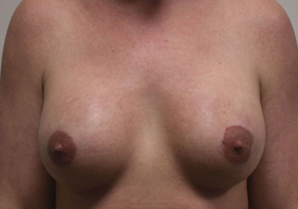 Breast Augmentation Case 683 - After