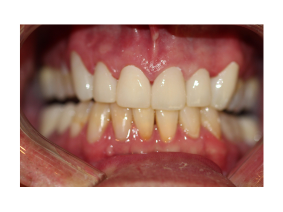 Smile Makeovers, actual cases of our dentists, no special lighting or editing Case 15 - After