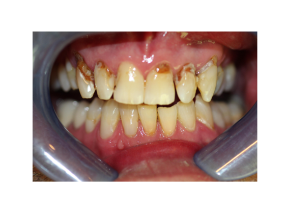 Smile Makeovers, actual cases of our dentists, no special lighting or editing Case 15 - Before