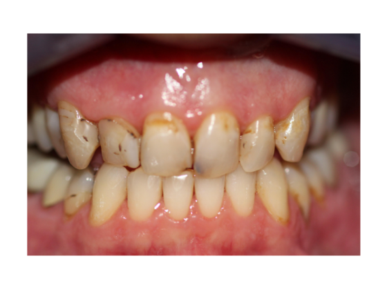Smile Makeovers, actual cases of our dentists, no special lighting or editing Case 16 - Before