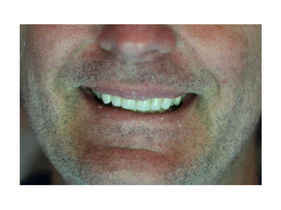 Smile Makeovers, actual cases of our dentists, no special lighting or editing Case 16 - After