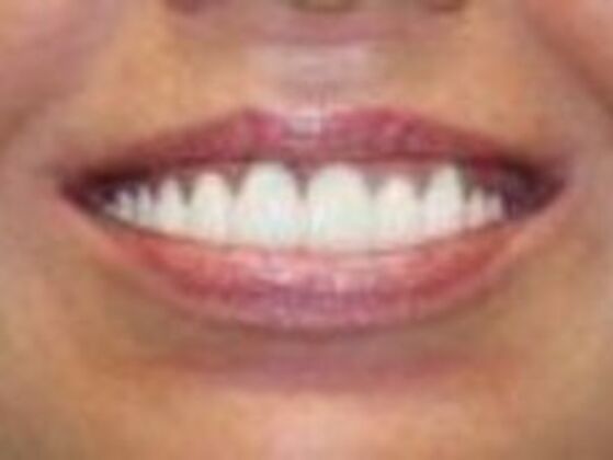 Smile Makeovers, actual cases of our dentists, no special lighting or editing Case 17 - After