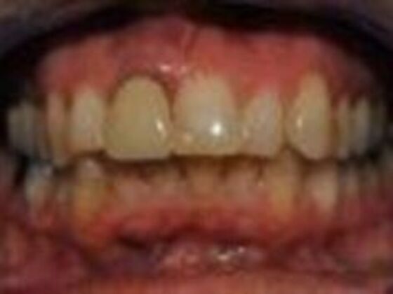 Smile Makeovers, actual cases of our dentists, no special lighting or editing Case 17 - Before