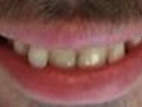 Smile Makeovers, actual cases of our dentists, no special lighting or editing Case 18 - Before