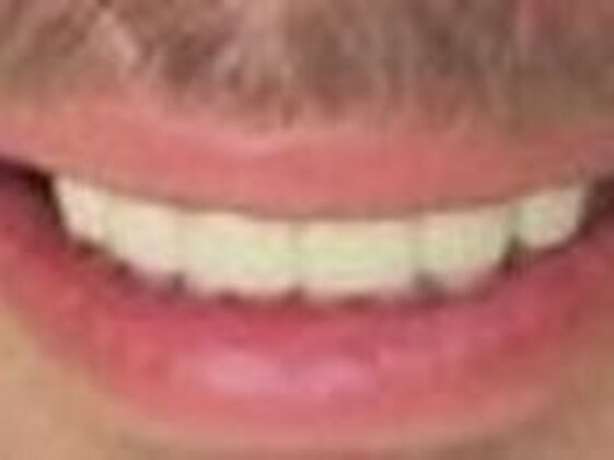 Smile Makeovers, actual cases of our dentists, no special lighting or editing Case 18 - After