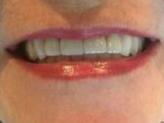 Smile Makeovers, actual cases of our dentists, no special lighting or editing Case 19 - After