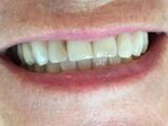 Smile Makeovers, actual cases of our dentists, no special lighting or editing Case 19 - Before